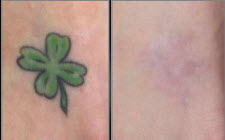 before and after tattoo removal