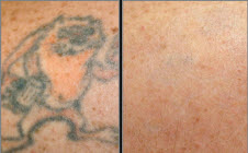 tattoos removed